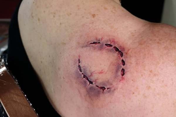 tatouage morsure