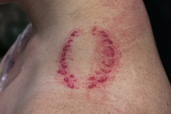 tatouage morsure