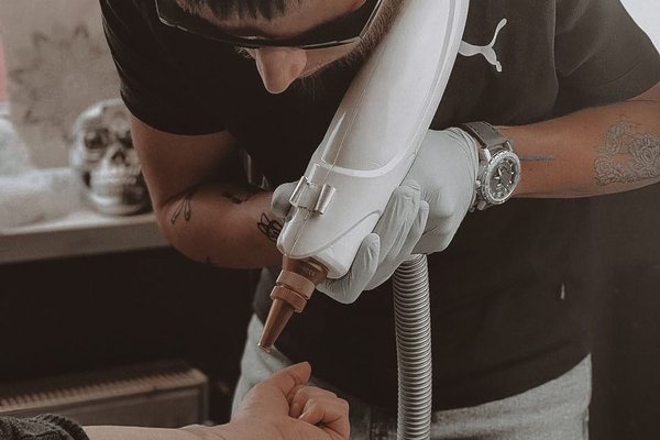 Le détatouage laser à Montpellier