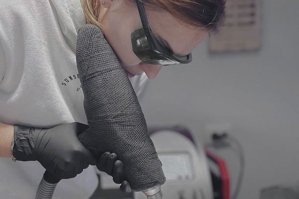Le détatouage laser à Montpellier